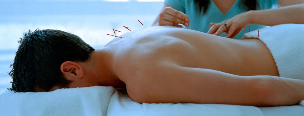 Practitioner placing acupuncture needles in a person's back