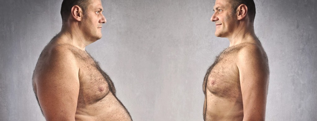 Man before and after roux-en-y gastric bypass procedure