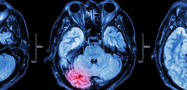 Brain scans with a highlighted area