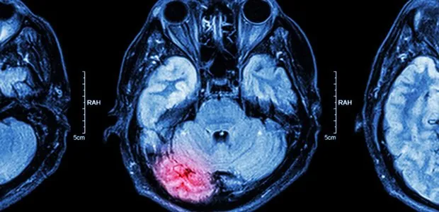 Brain scan with a highlighted area
