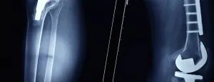 X-rays showing a knee replacement