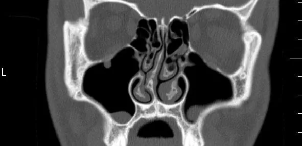 Deviated Septum Deviated Septum