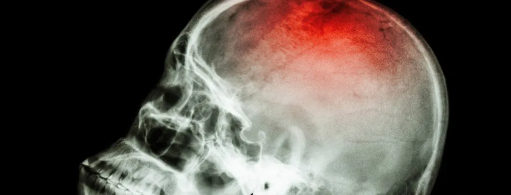 Medical illustration highlighting an area of the brain
