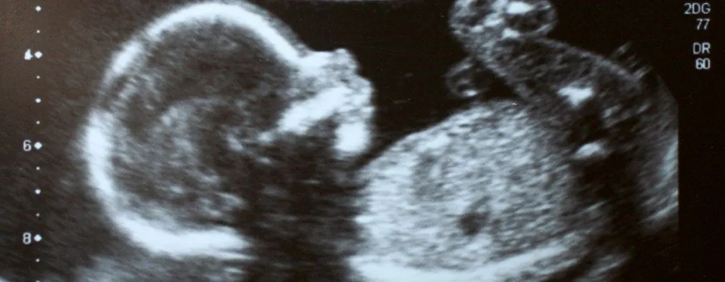 Ultrasound image of a fetus