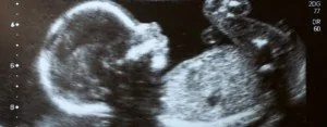 Ultrasound image of a fetus