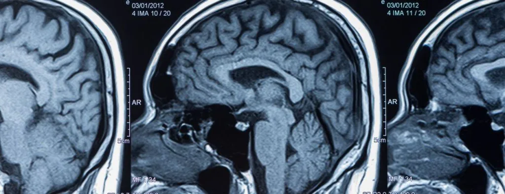 Series of brain scans