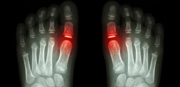 Illustration highlighting the big-toe joints